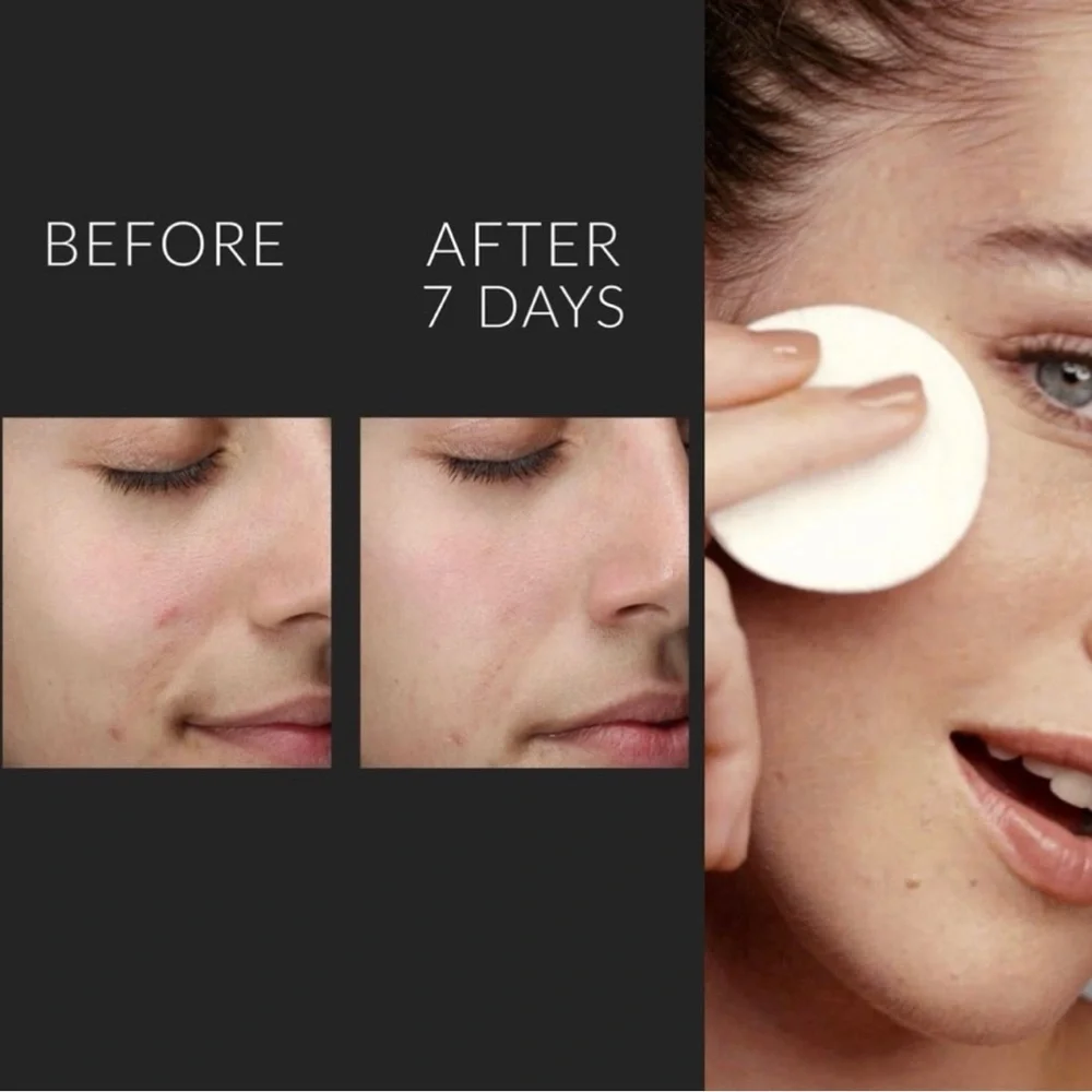 New KATE SOMMERVILLE Liquid ExfoliKate Tripple Acid Resurfacing Treatment - Picture 5 of 8